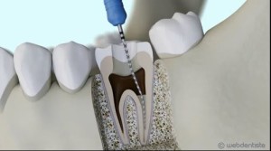 Technique d’implant molaire