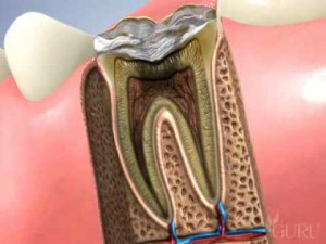 Traitement canal dentaire et pose d'un inlay-core